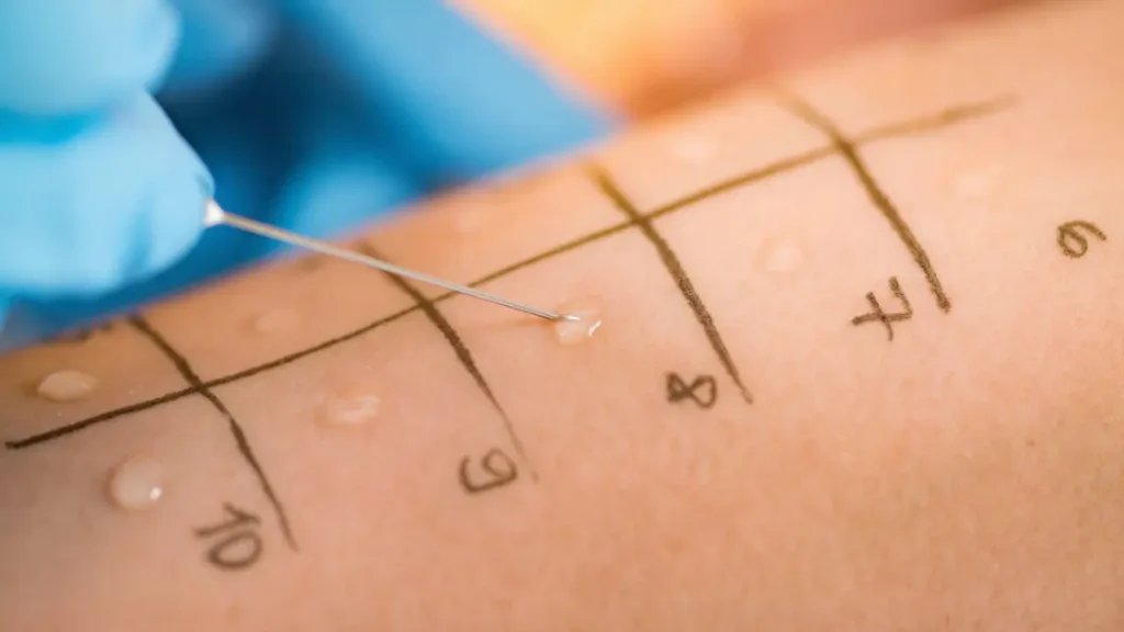 skin prick test for allergies