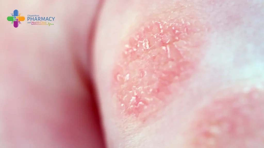 Photo of Eczema on the Skin