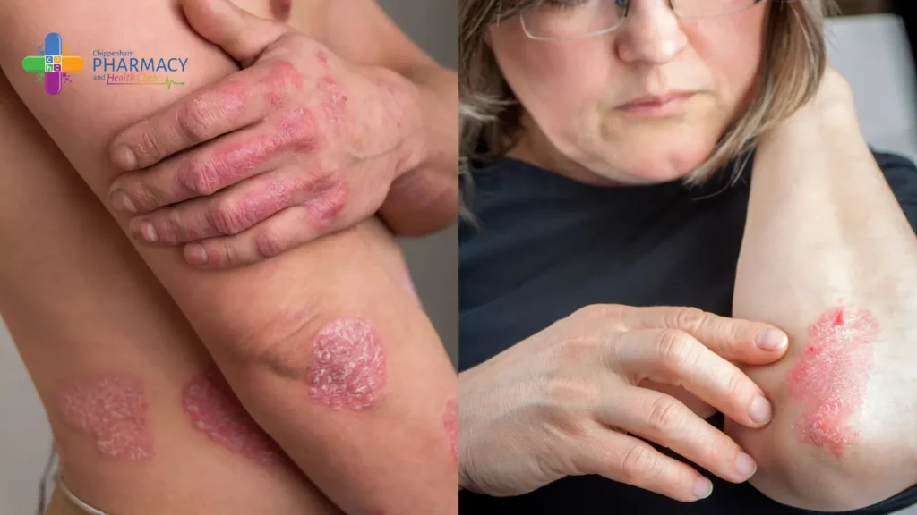 Photos of Psoriasis 
