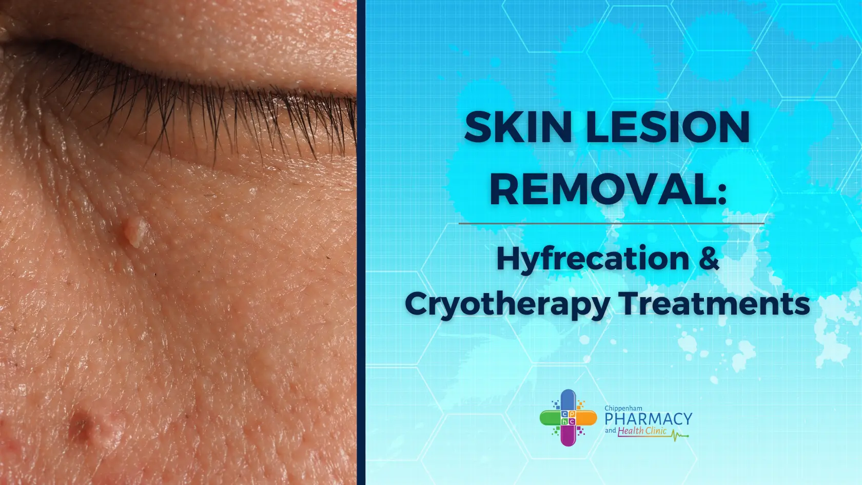 skin lesion removal treatment